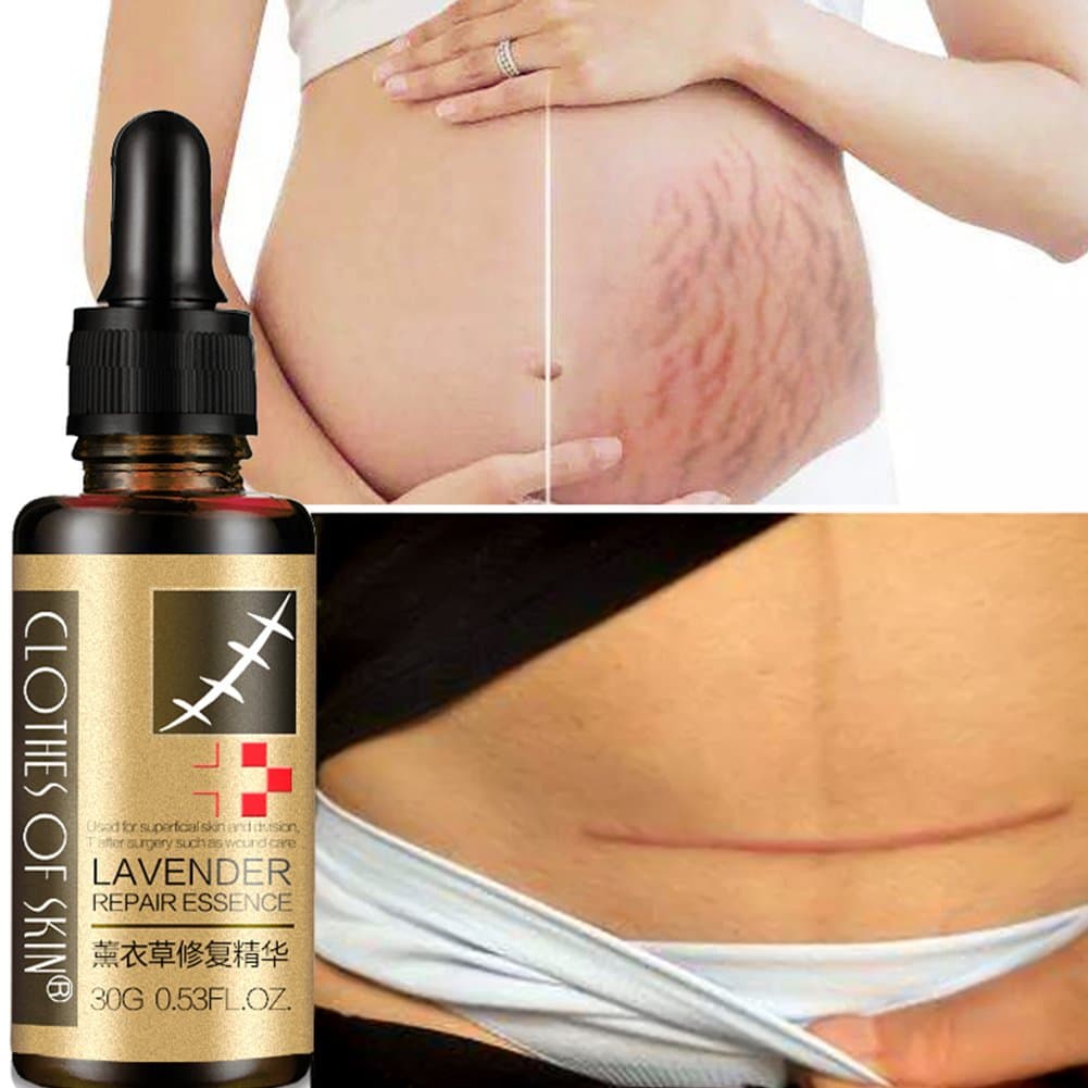 Onkessy Scar Removal Oil, Scar Repair Oil, Scar & Stretch Marks Removal Treatment, Lavender Repair Essence Scar Cream, Skin Care Oil, Body Oil, Skin Repair Cream, Hydrate & Brighten Skin 30ml