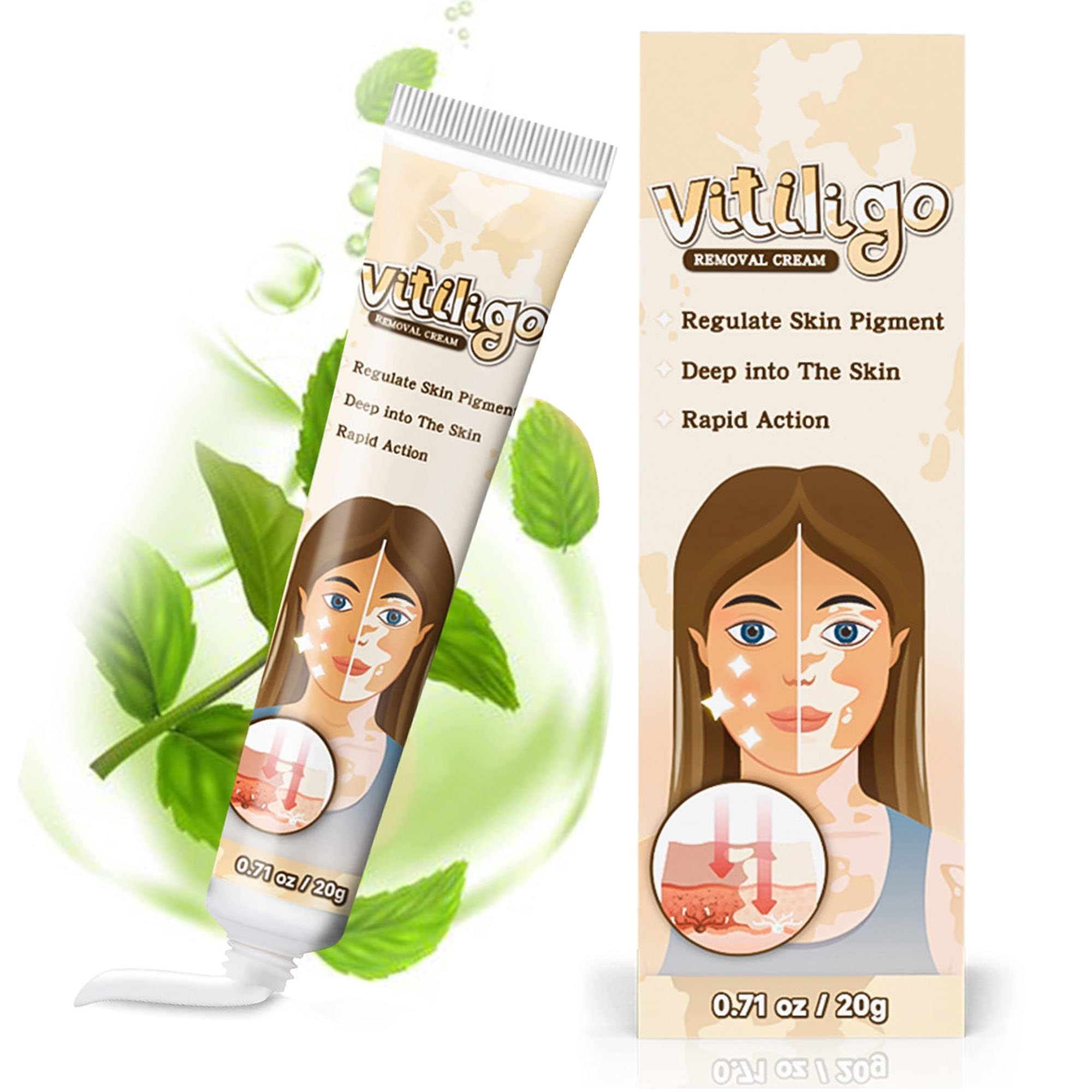Vitiligo Treatment, Vitiligo Cream Reduces for White Spots